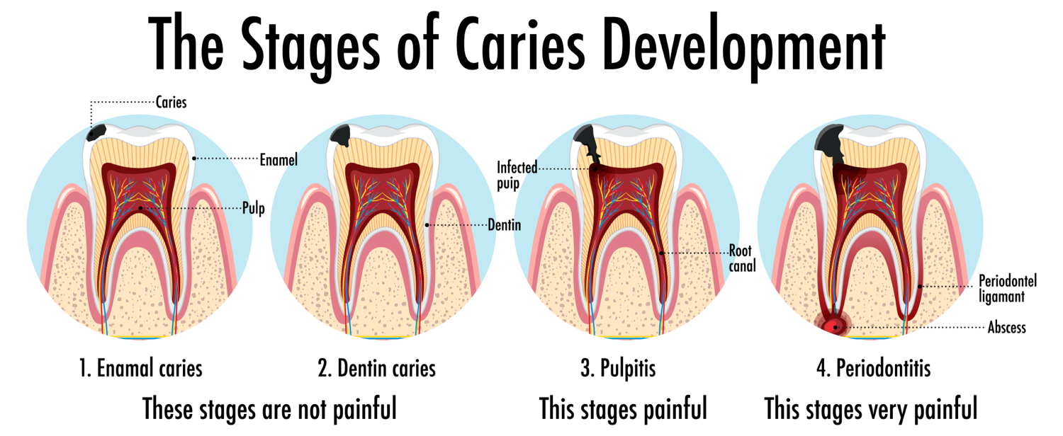cavity