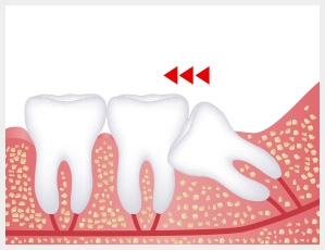 wisdom tooth