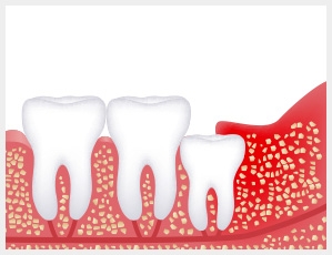 wisdom tooth
