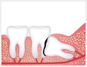 wisdom tooth