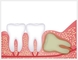 wisdom tooth