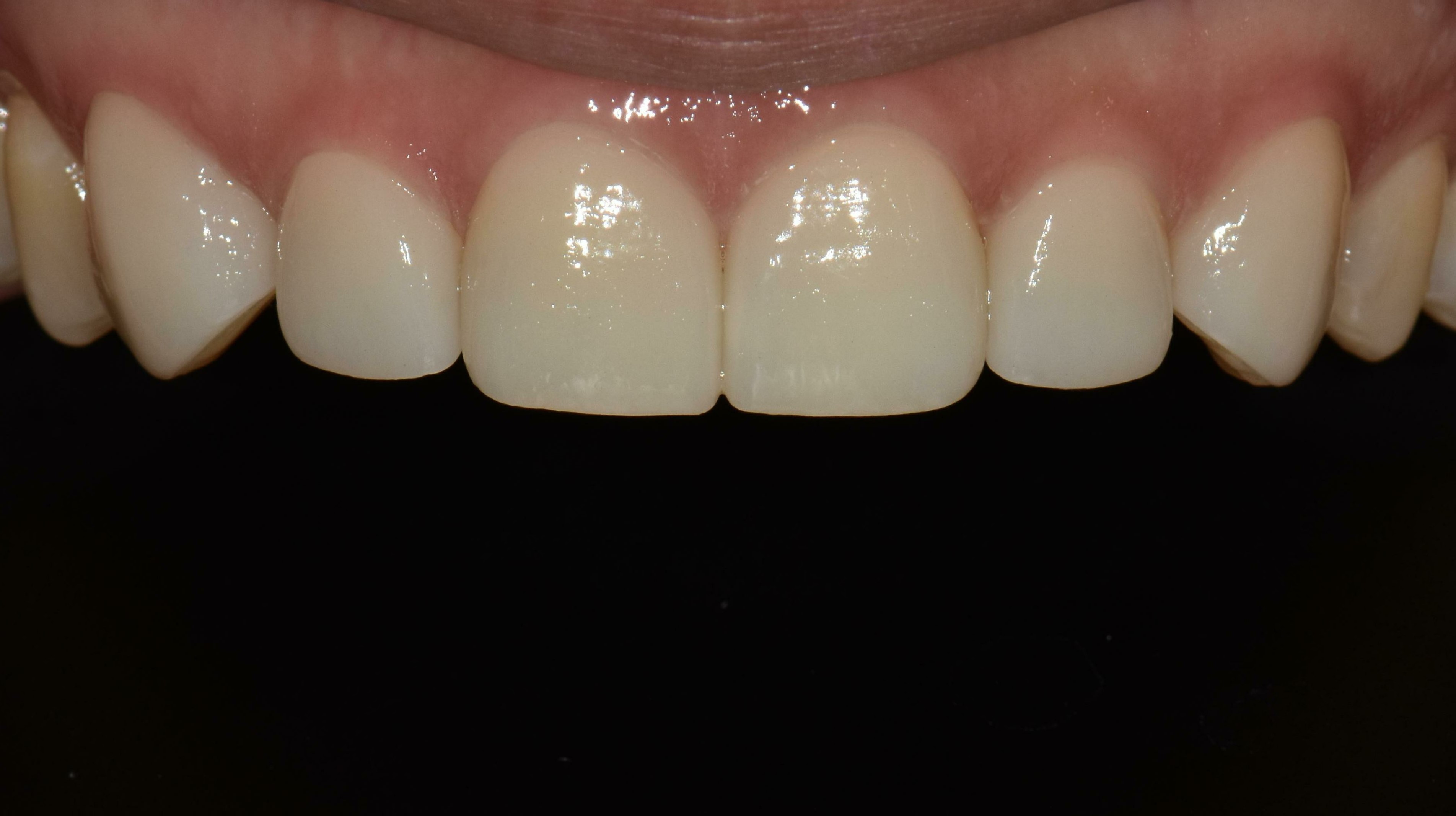 no prep veneers case