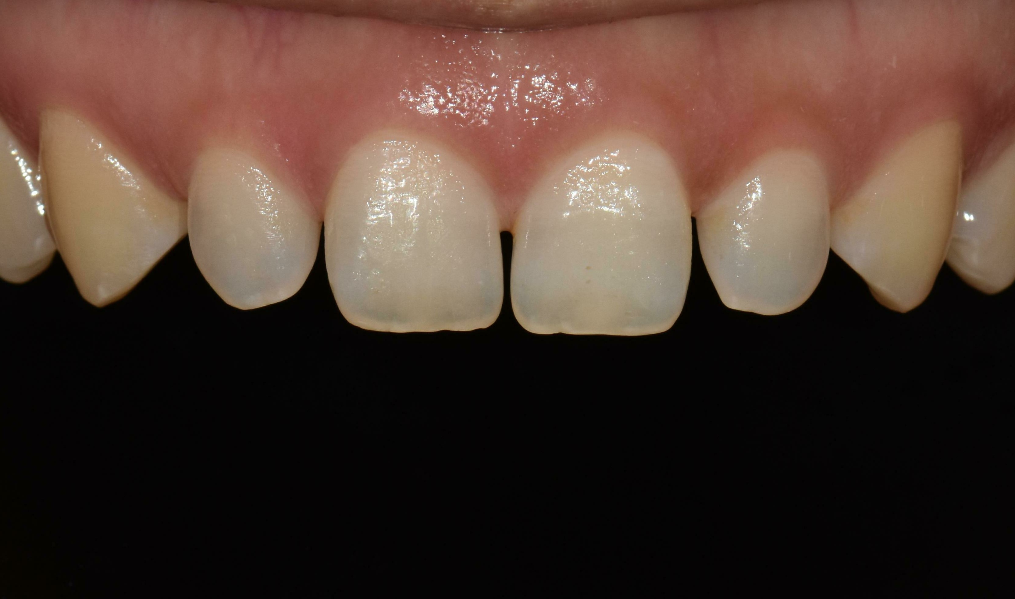 no prep veneers case