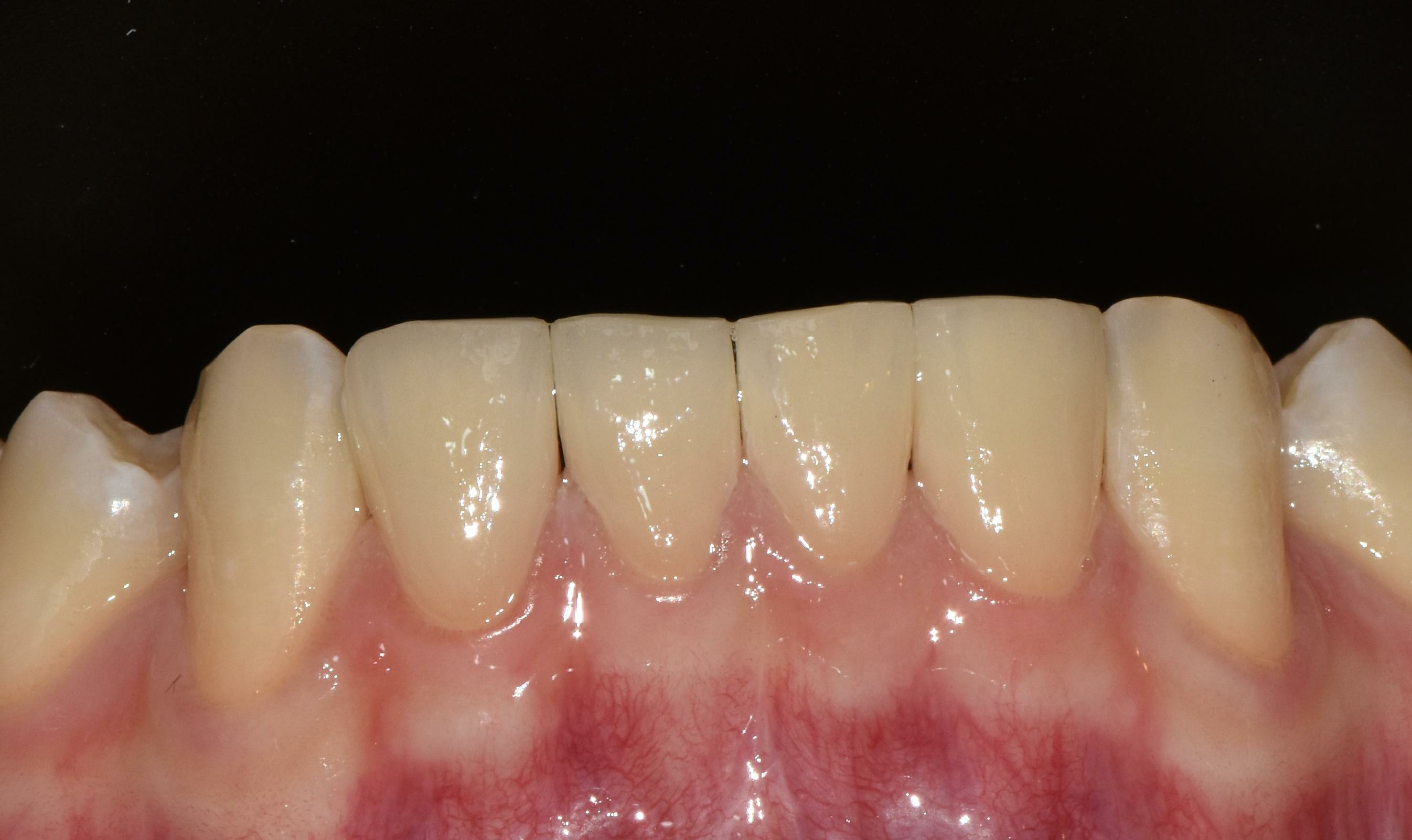 no prep veneers case