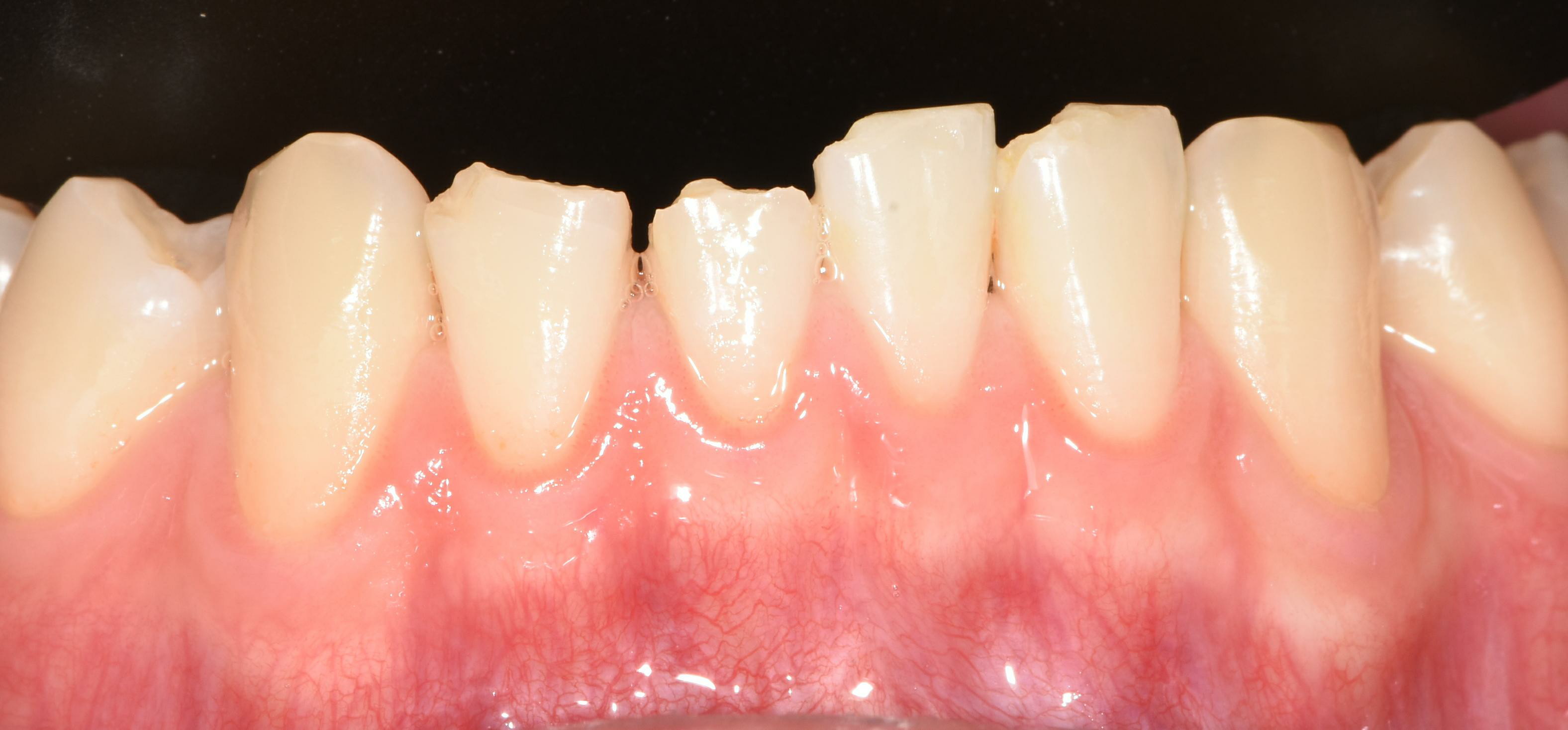no prep veneers case