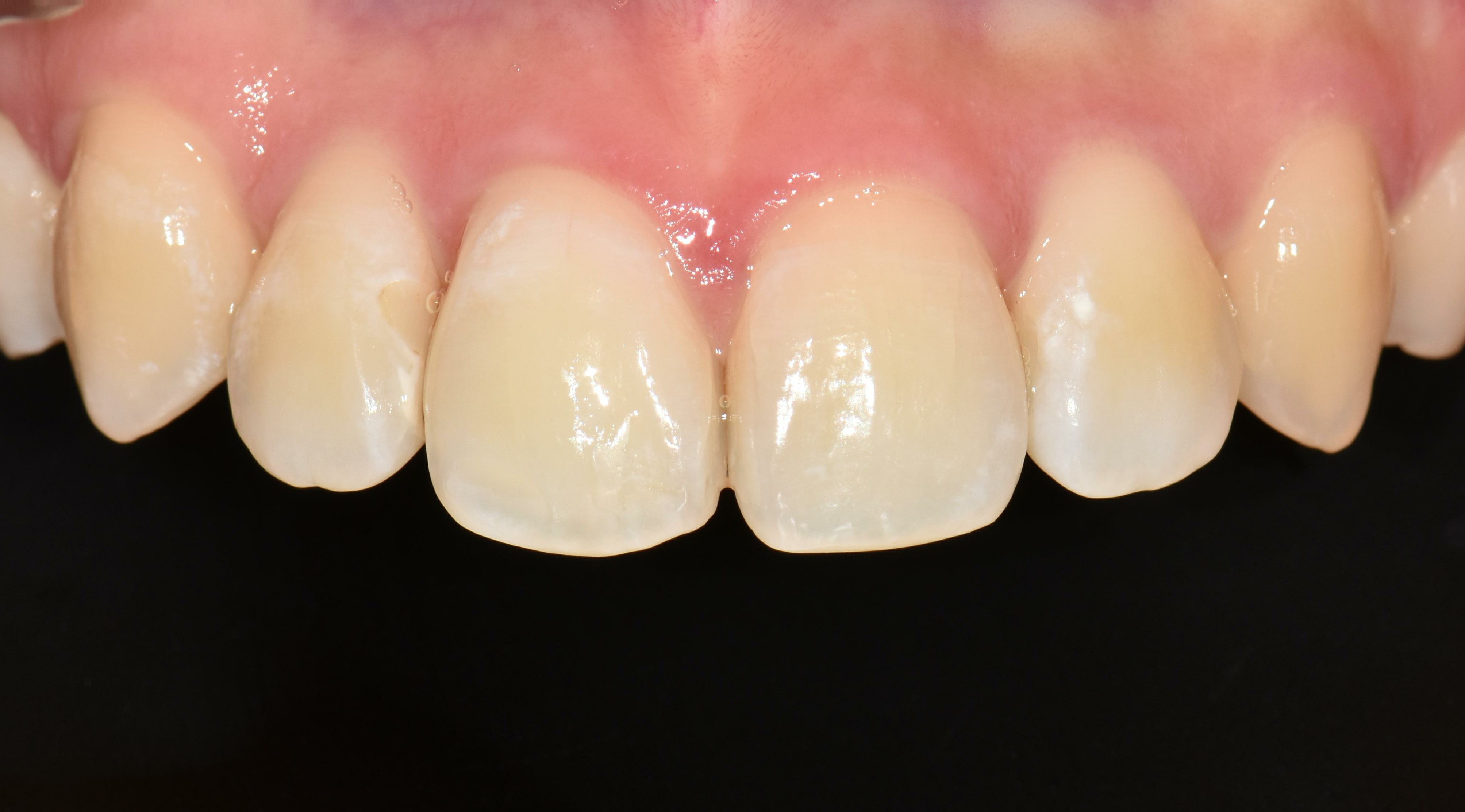 no prep veneers case