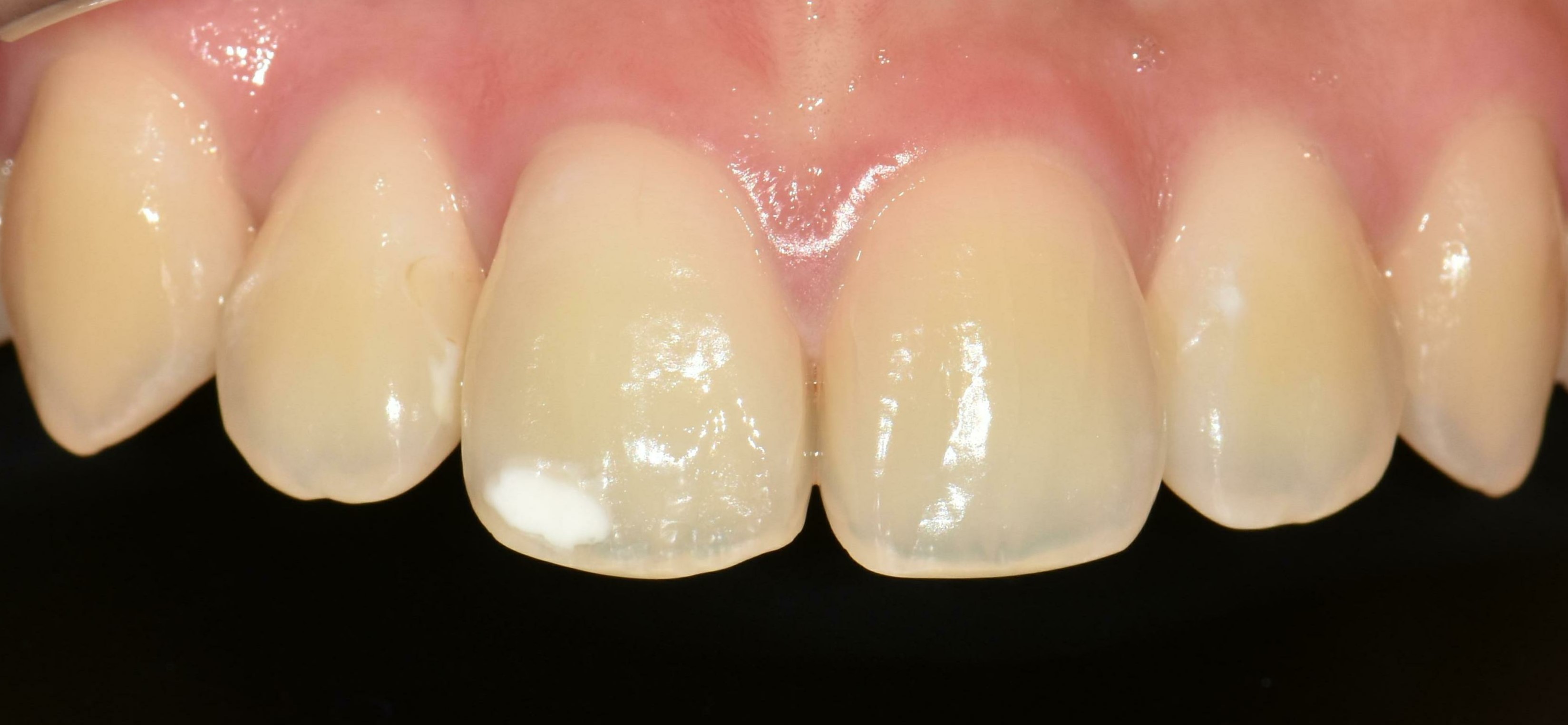 no prep veneers case