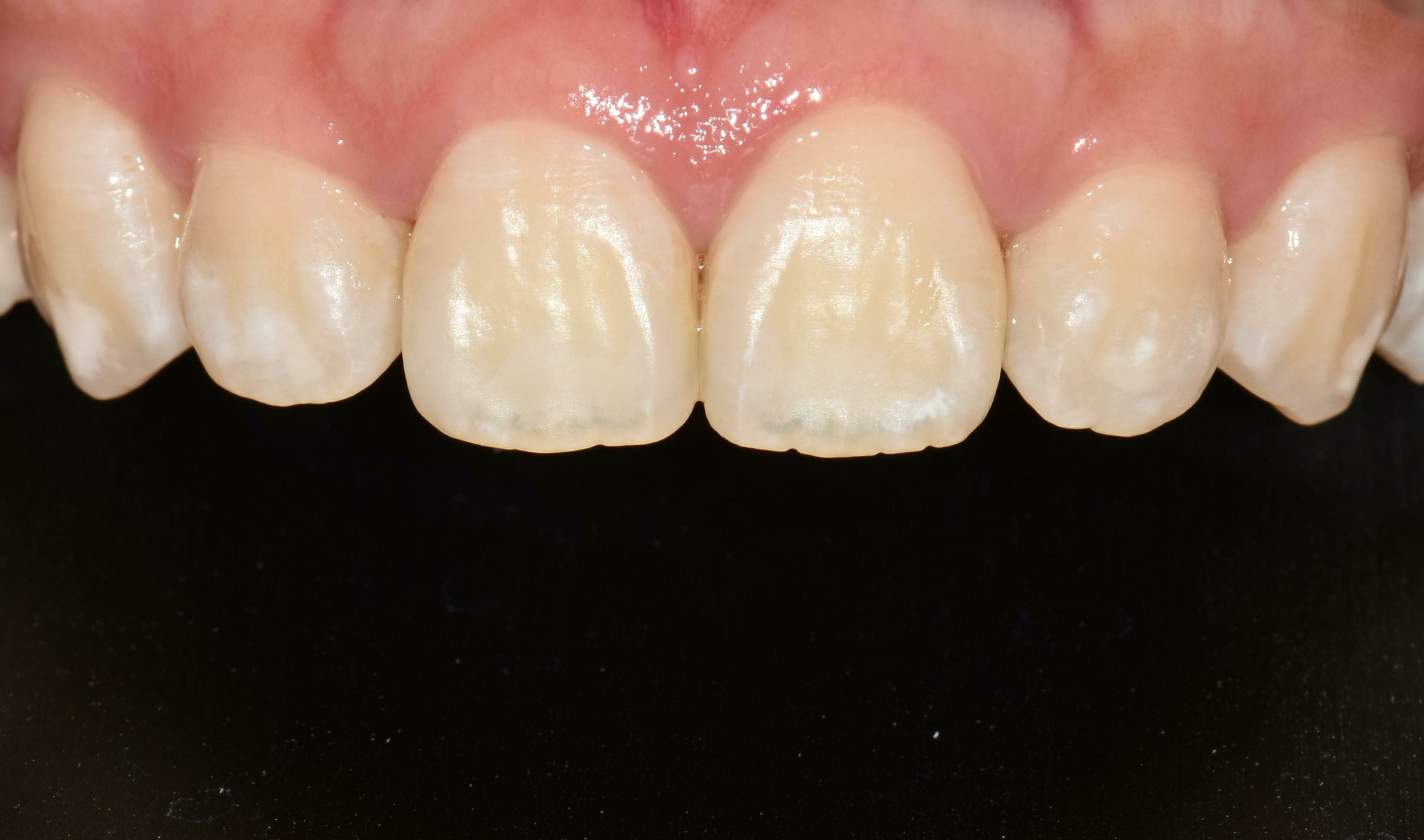 no prep veneers case