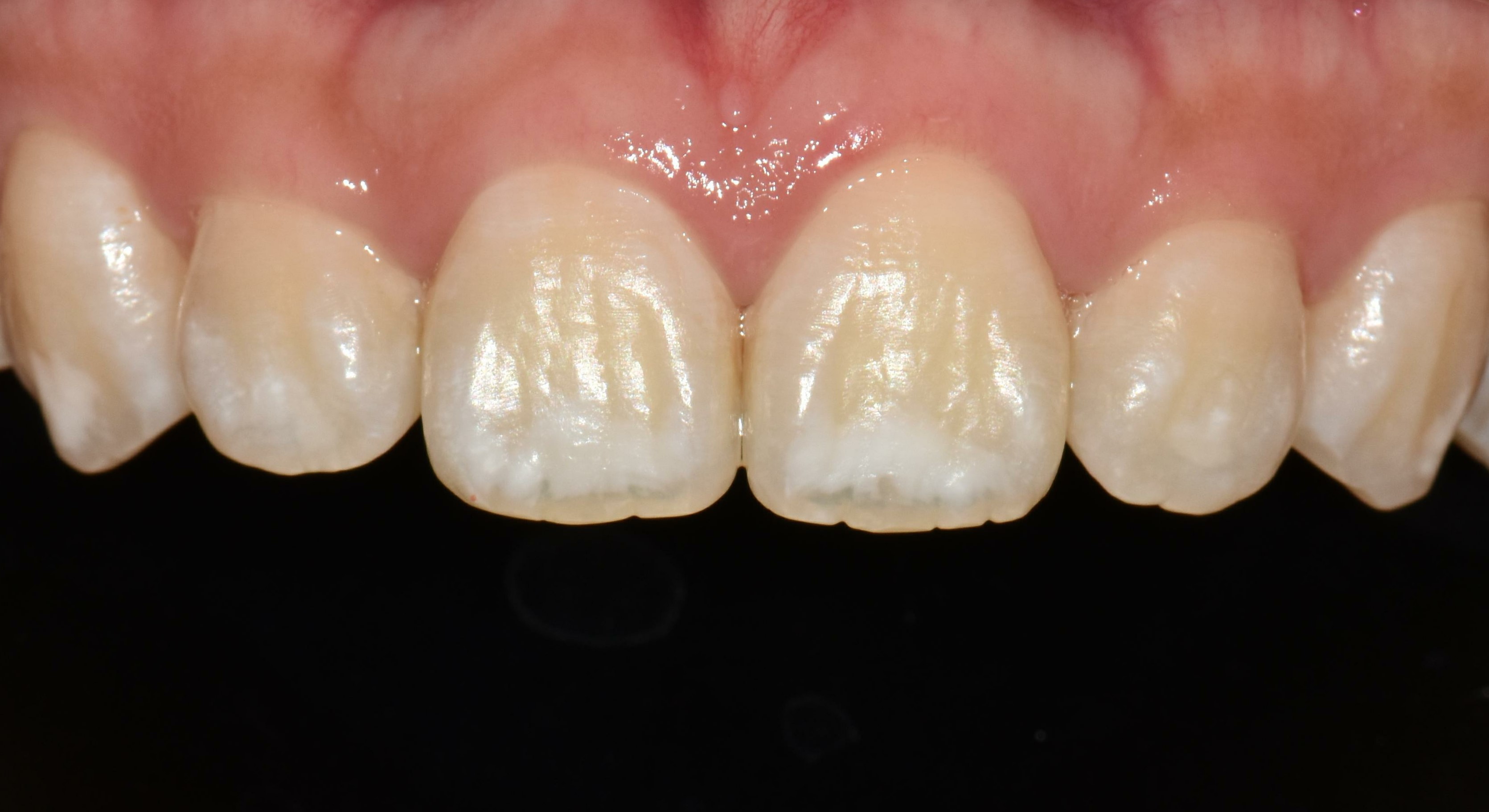 no prep veneers case