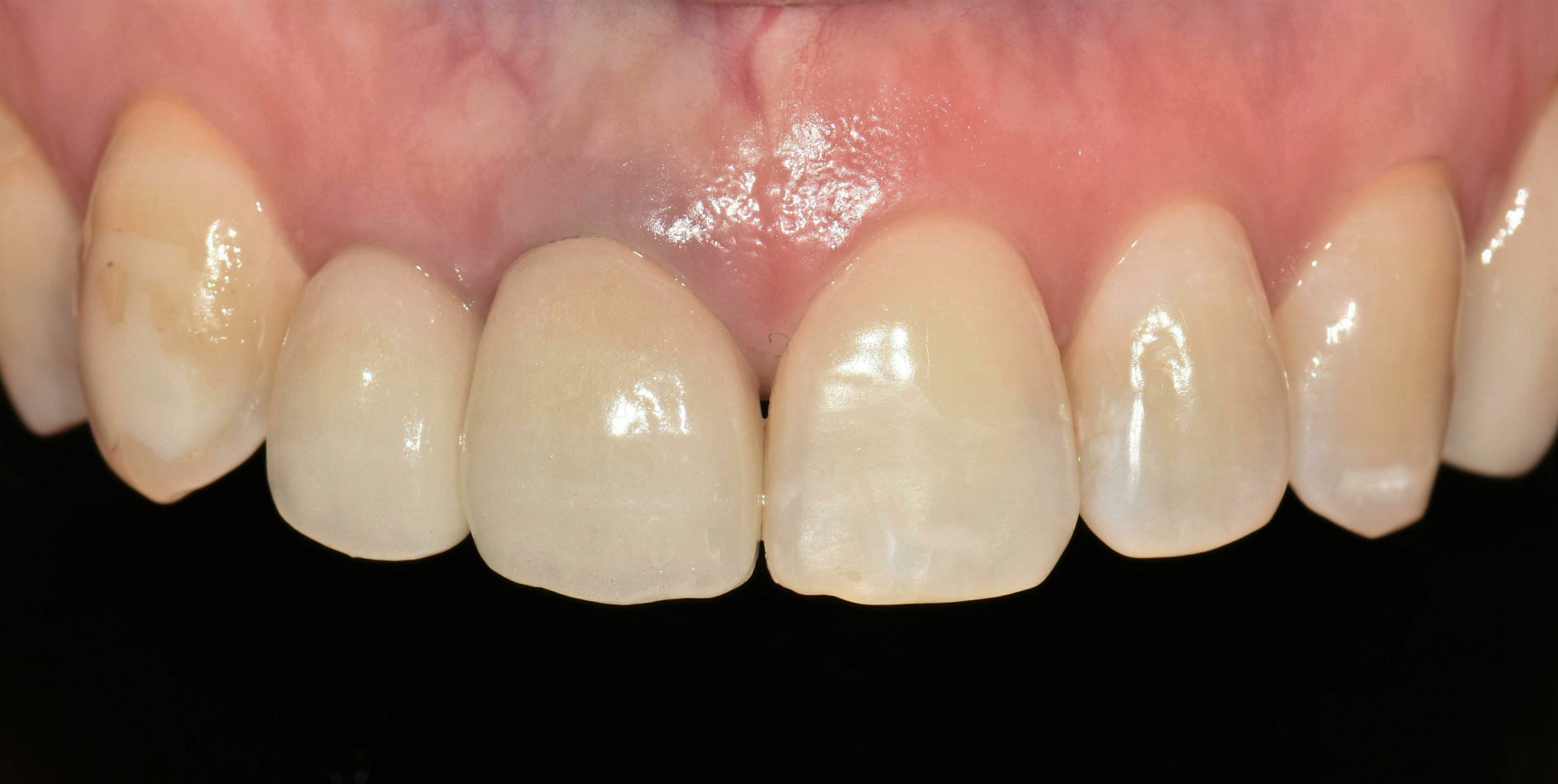 no prep veneers case