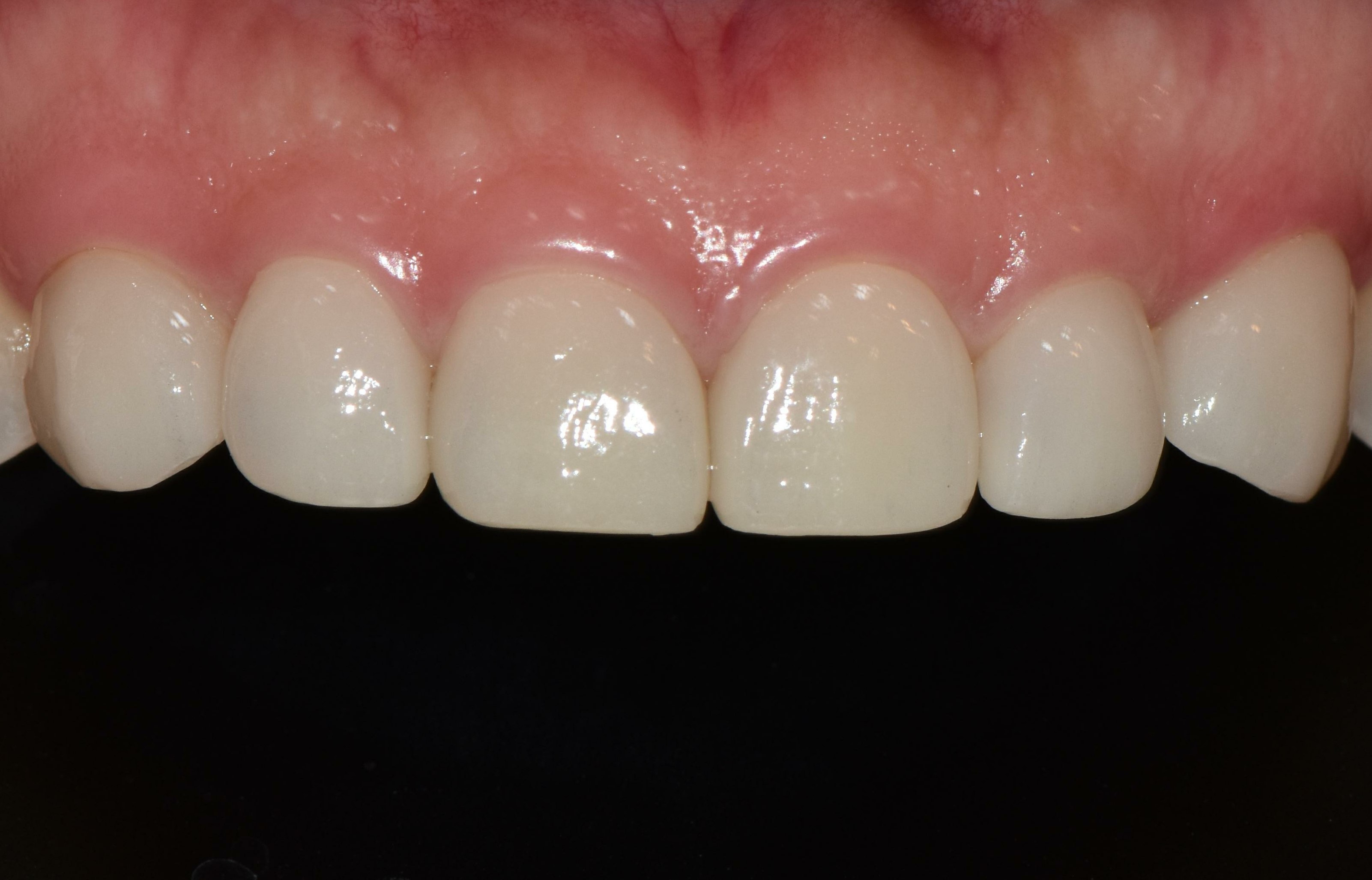 no prep veneers case
