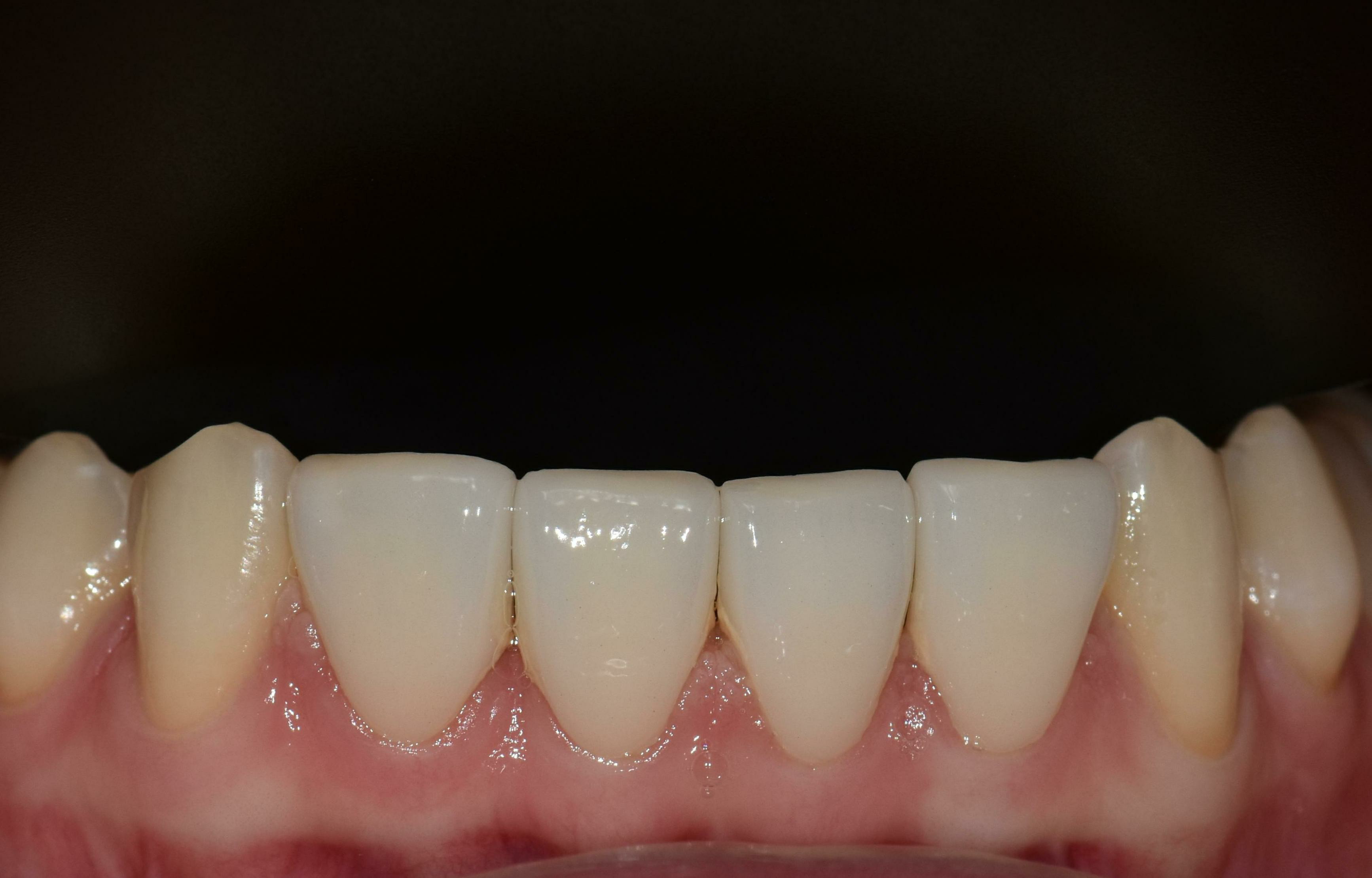 no prep veneers case