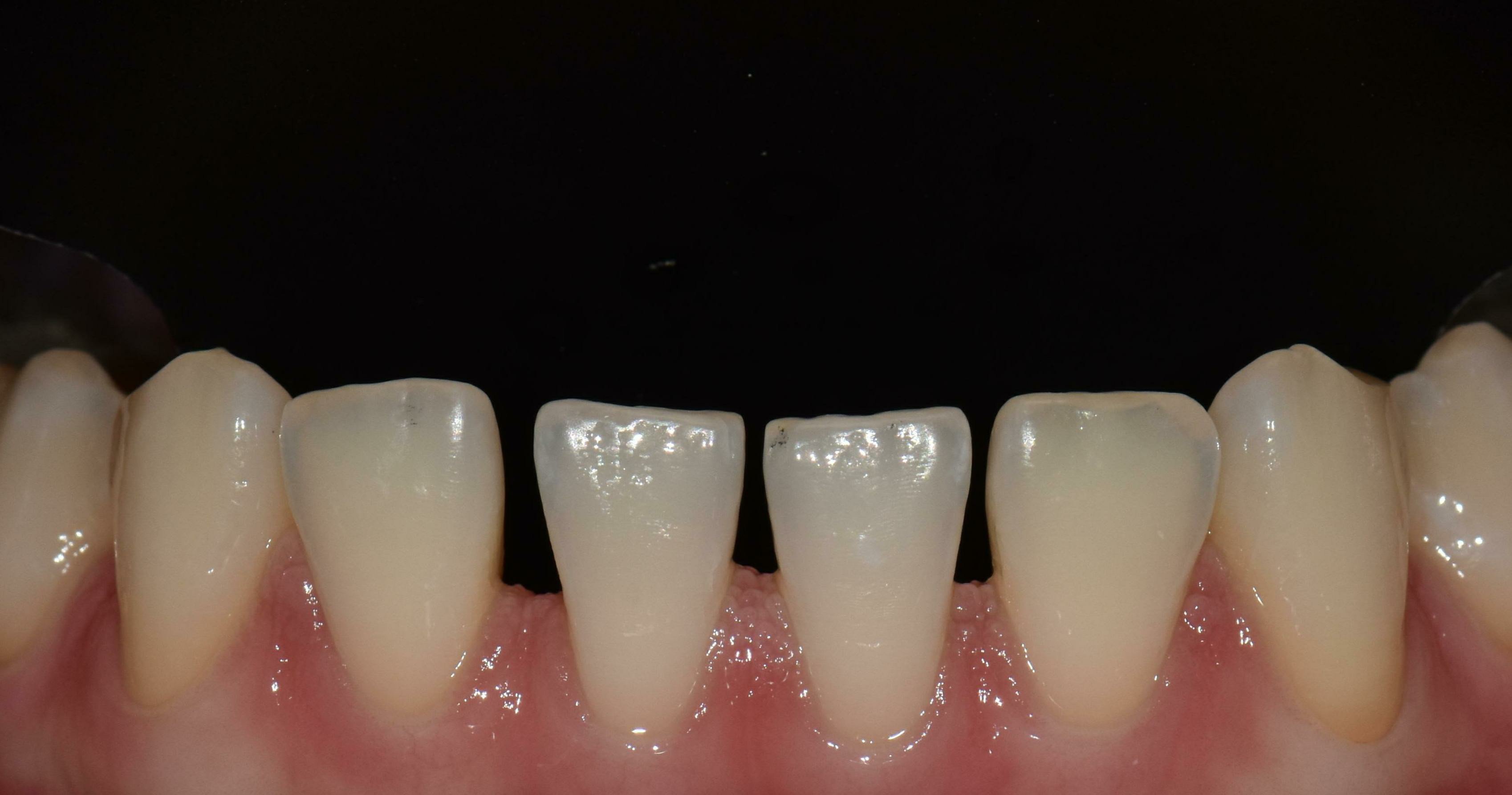 no prep veneers case