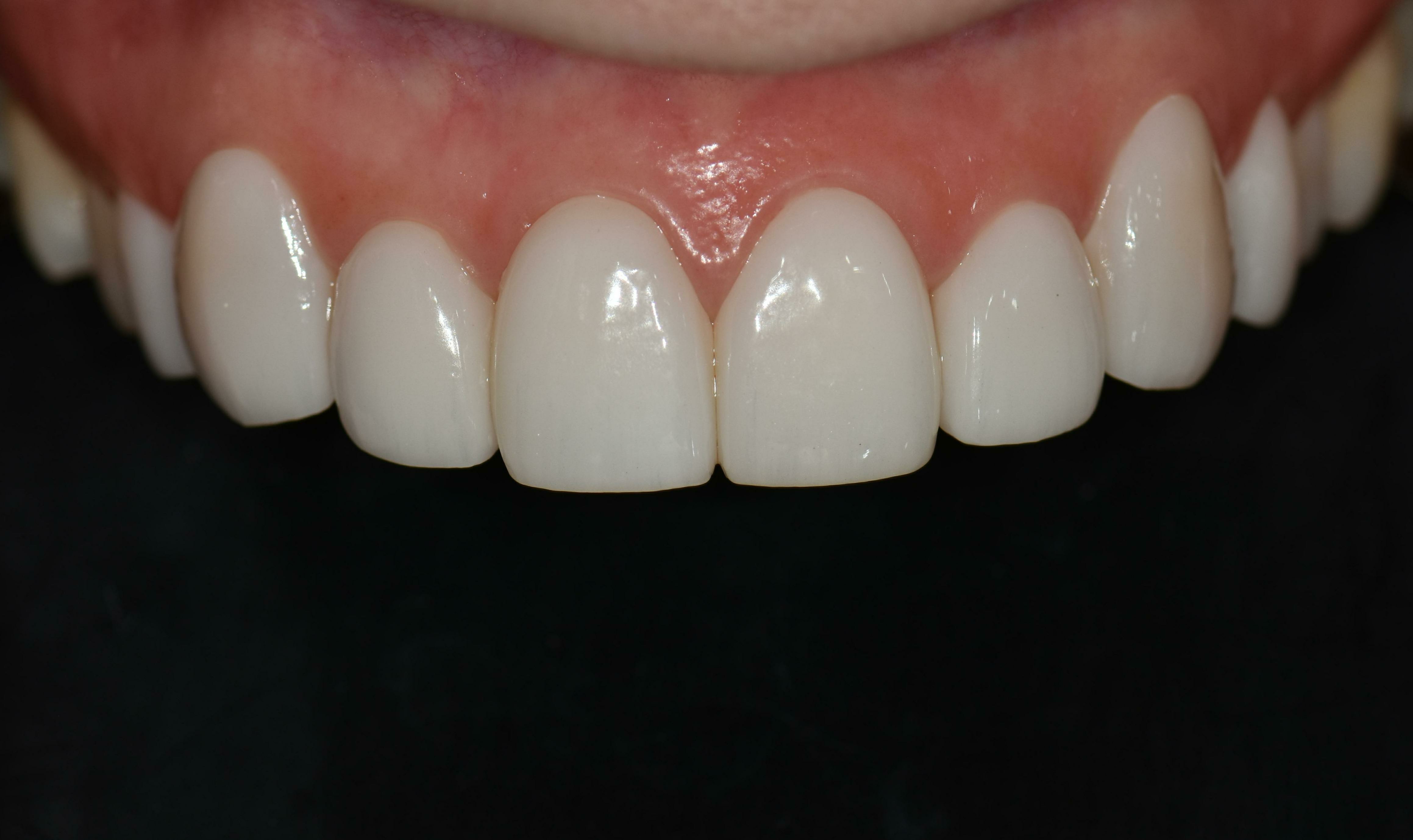 no prep veneers case