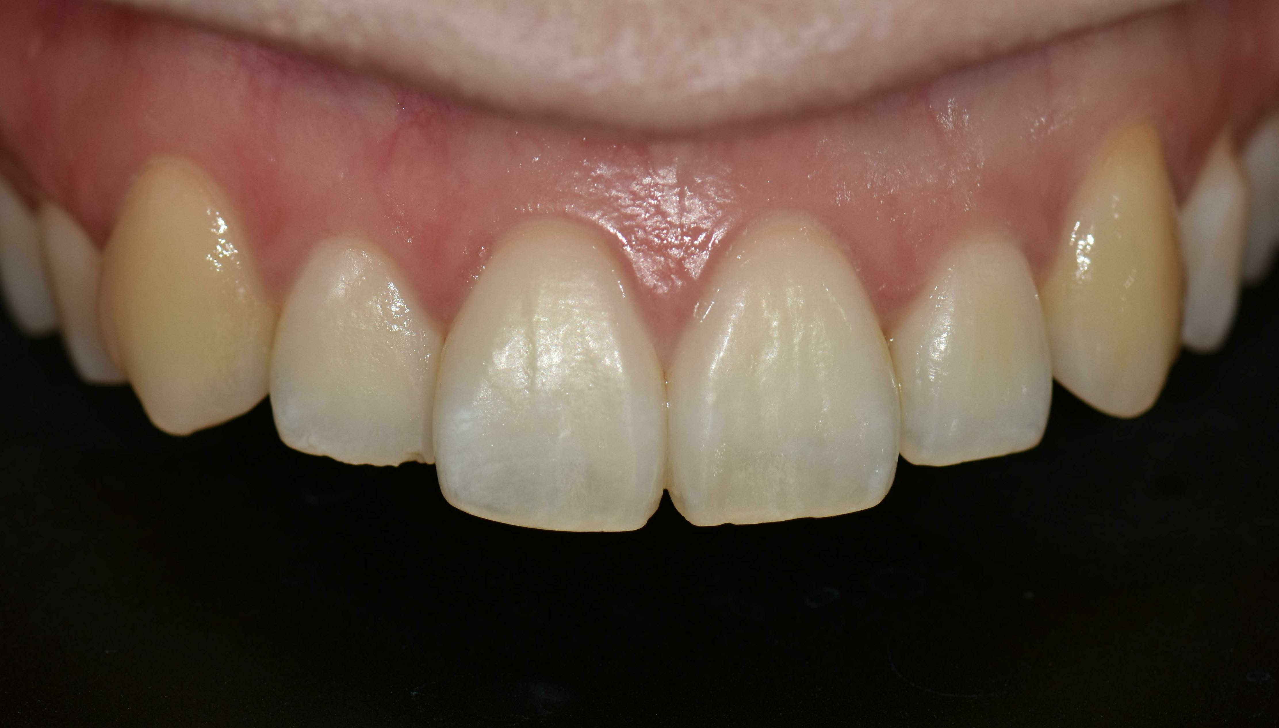 no prep veneers case
