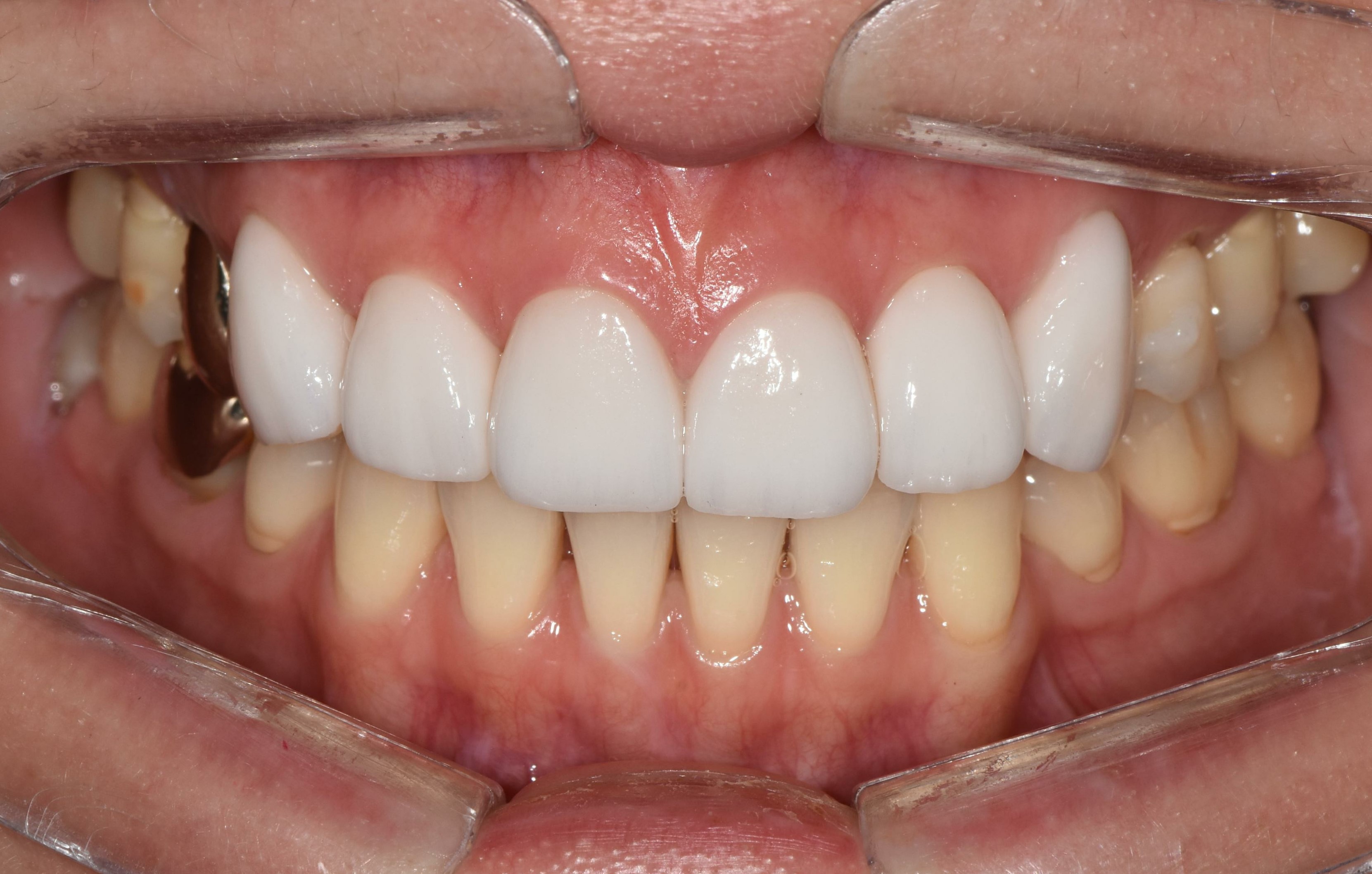 no prep veneers case