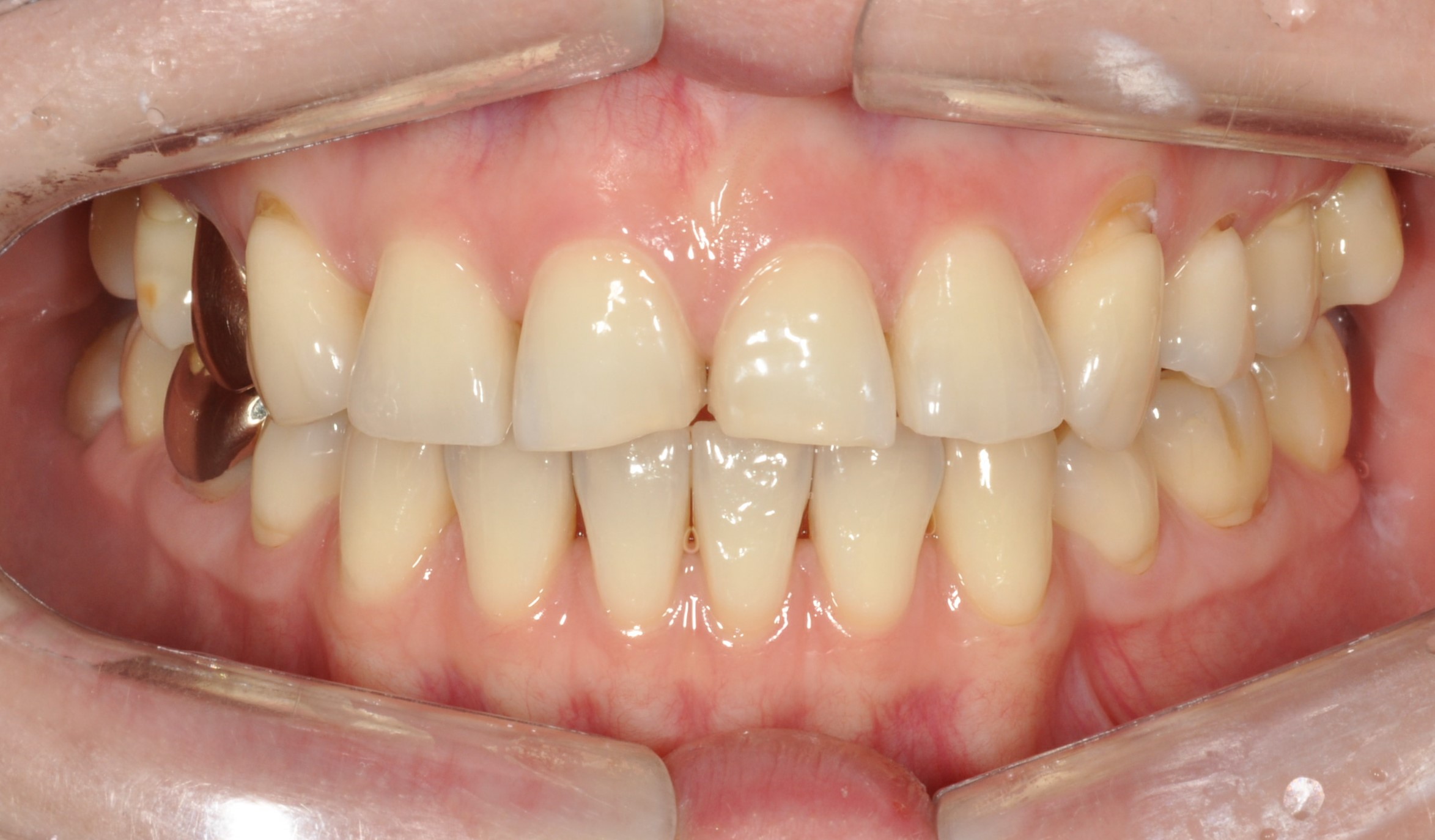 no prep veneers case