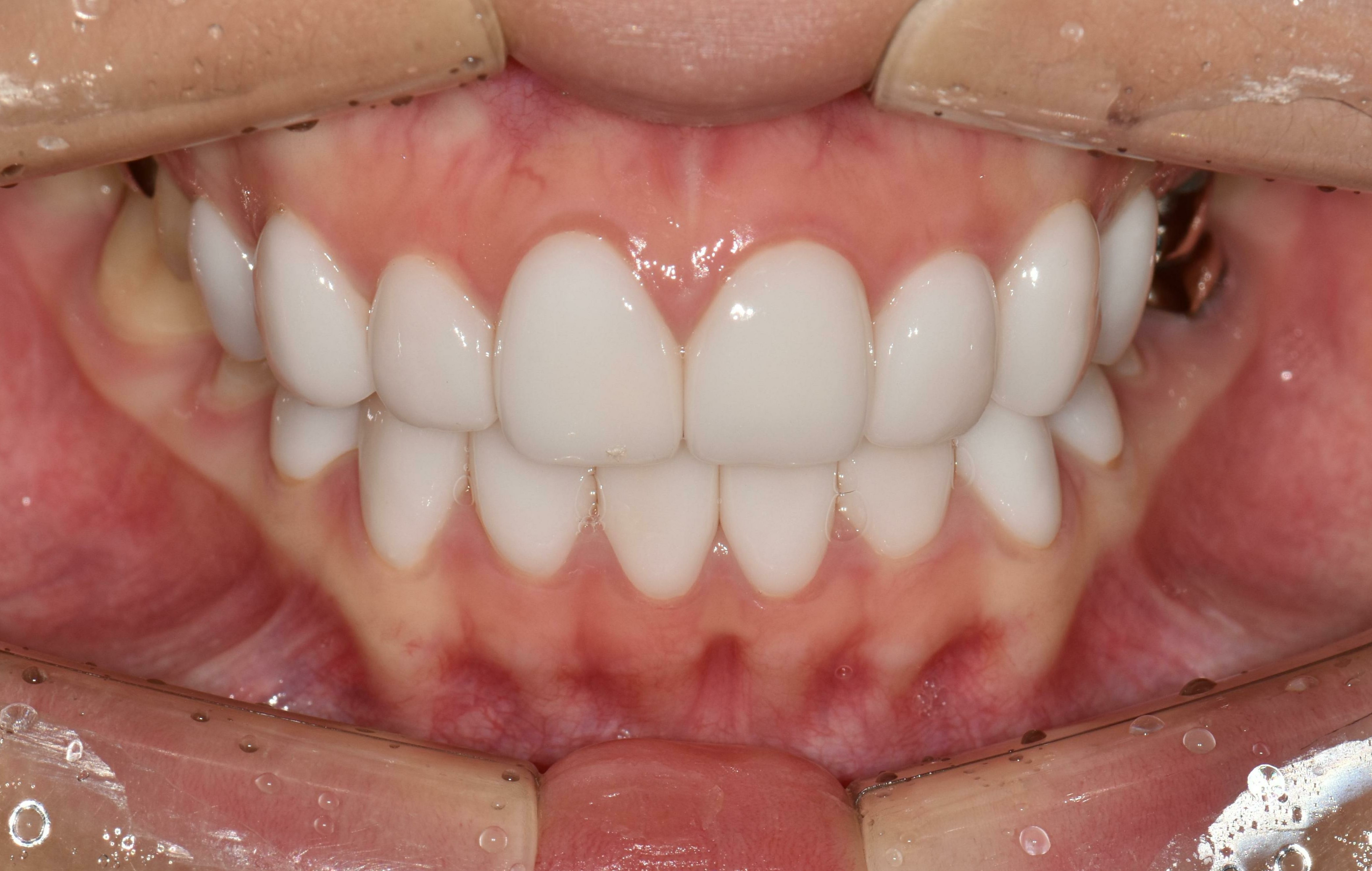 no prep veneers case