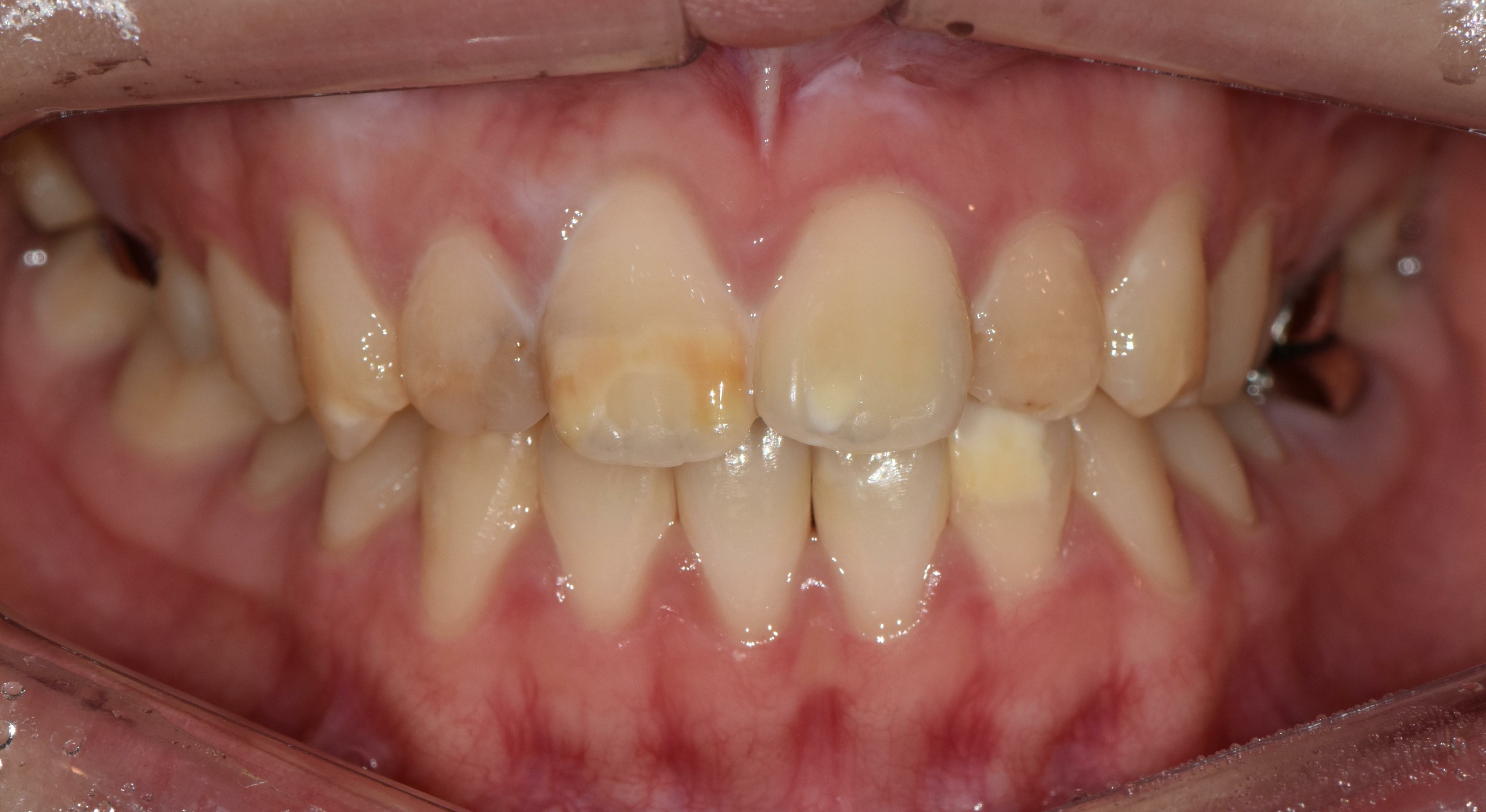 no prep veneers case