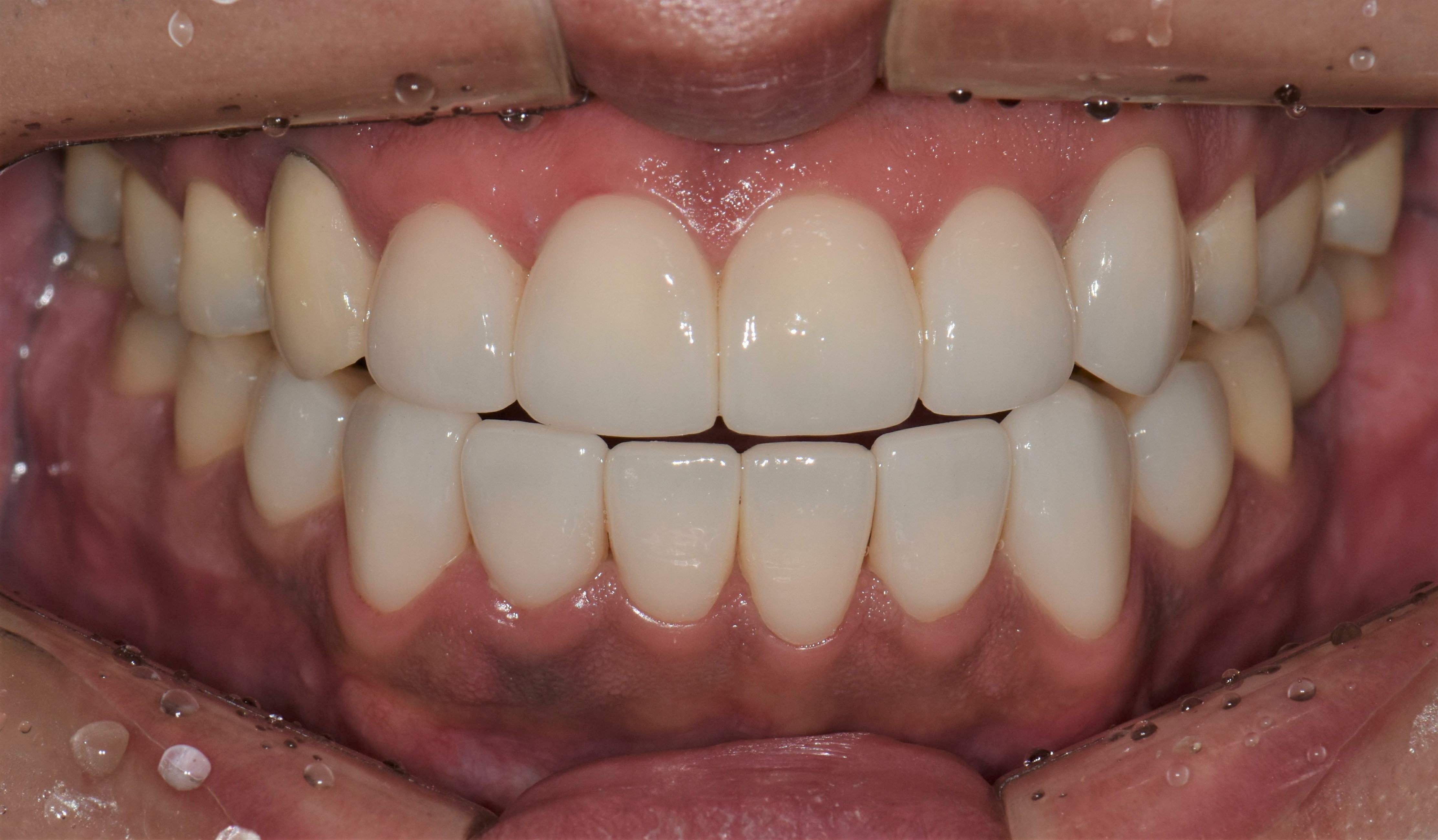 no prep veneers case