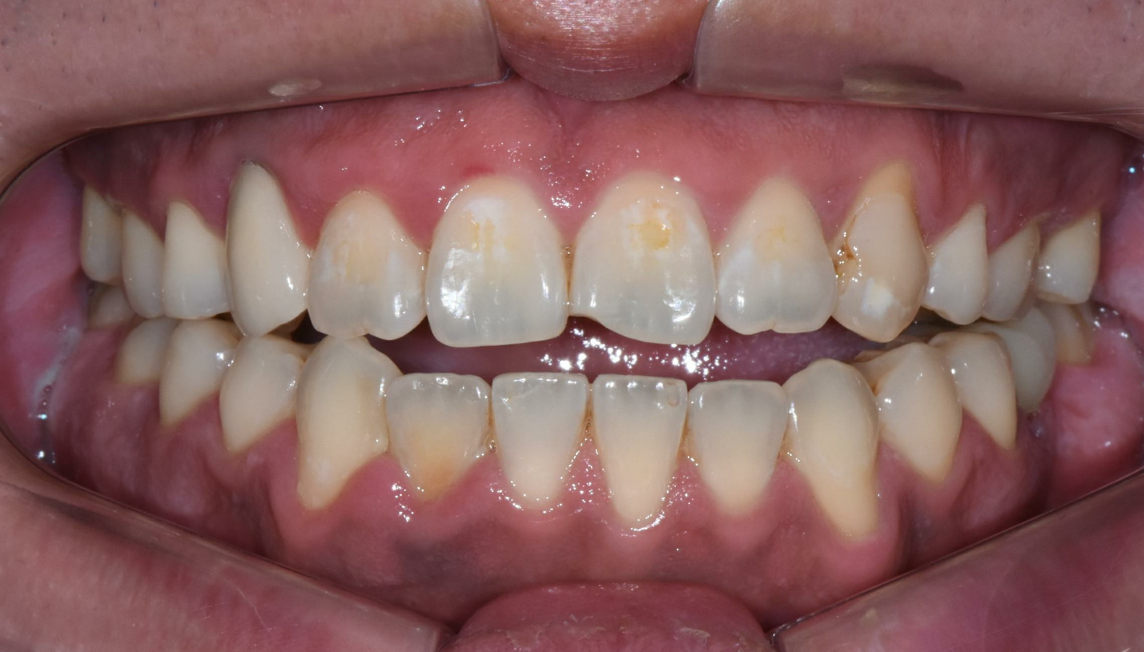 no prep veneers case