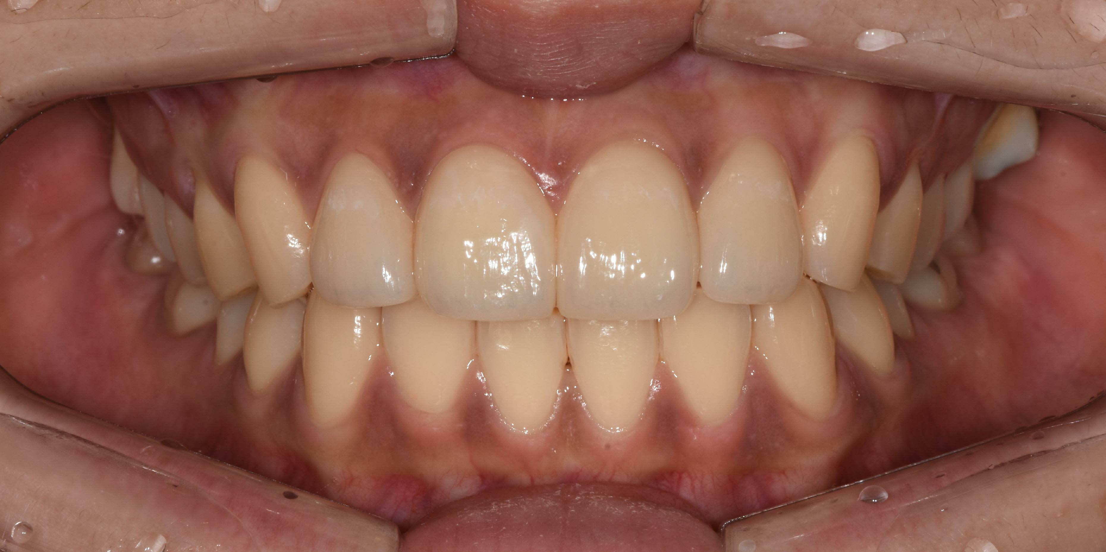 no prep veneers case