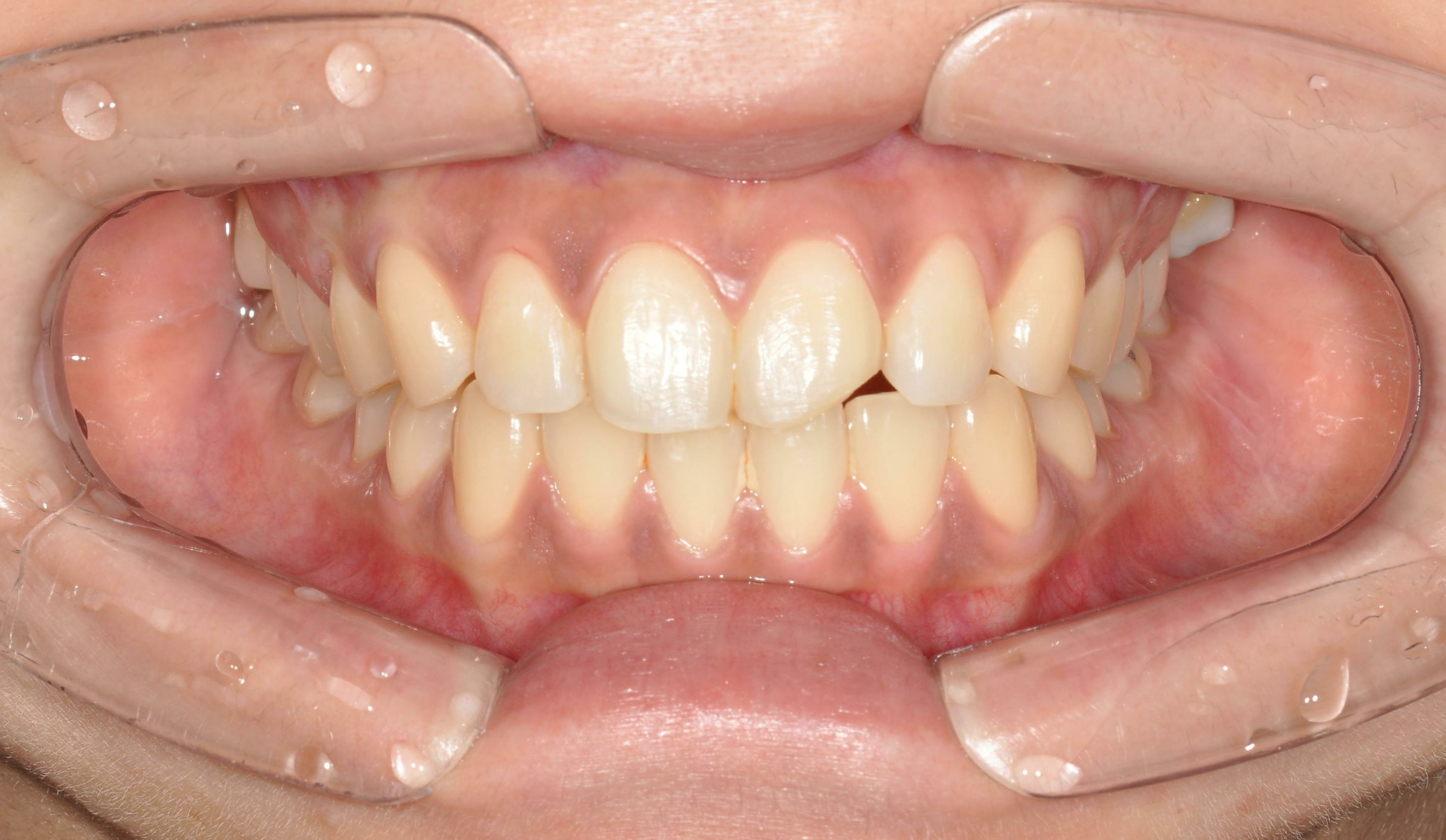 no prep veneers case