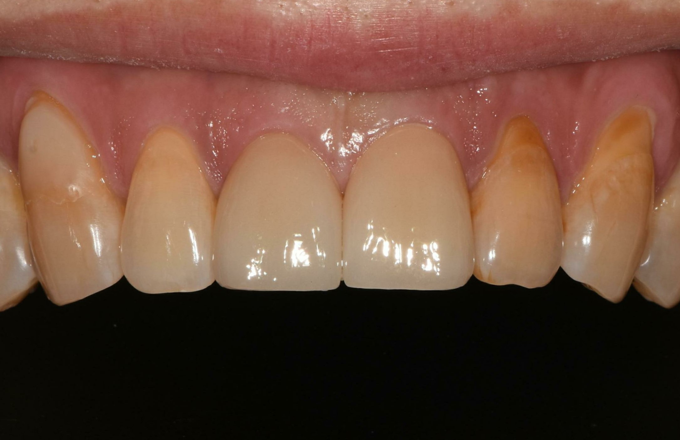 no prep veneers case