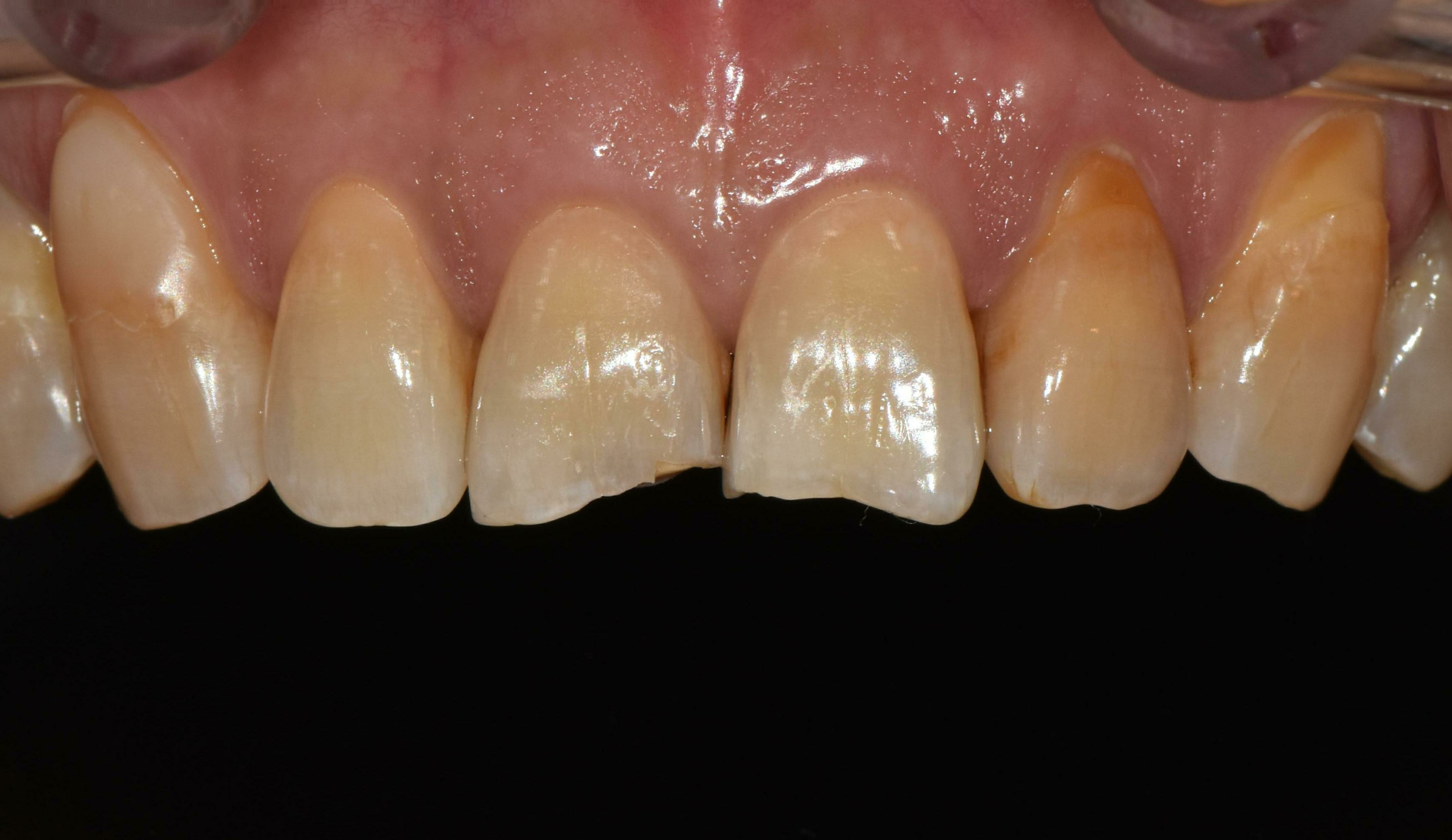 no prep veneers case
